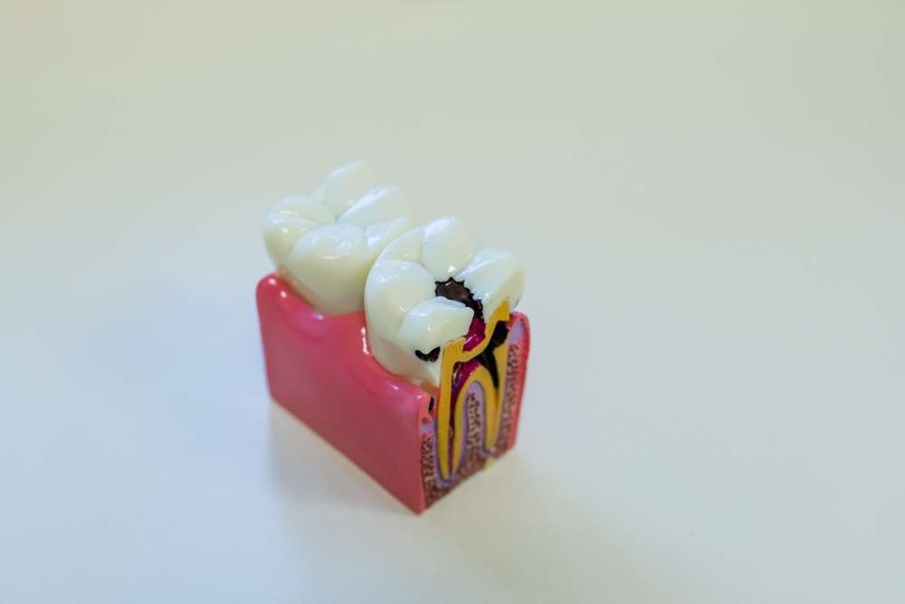 are root canals bad for you