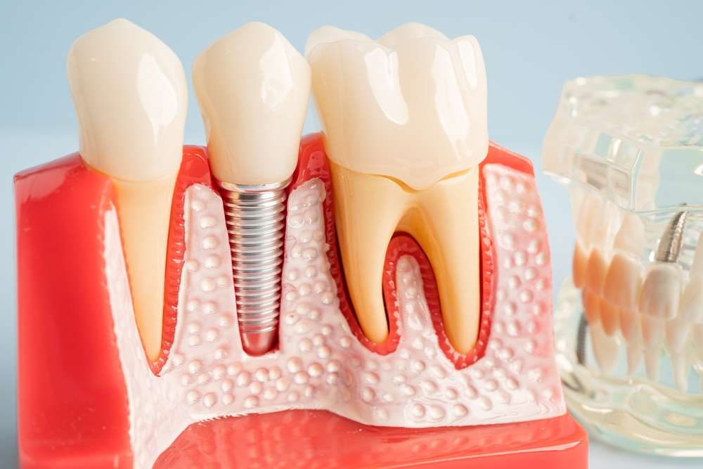 dental implants prices