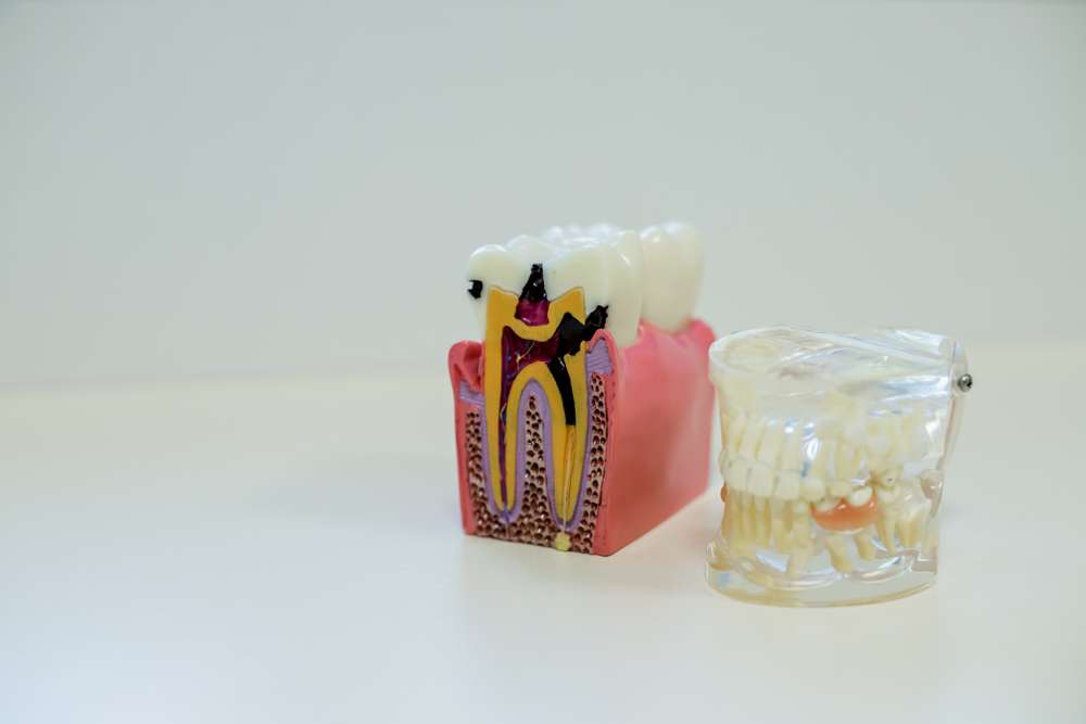 how to avoid root canal